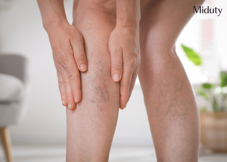 Exercises for Varicose Veins: How to Manage and Improve Circulation