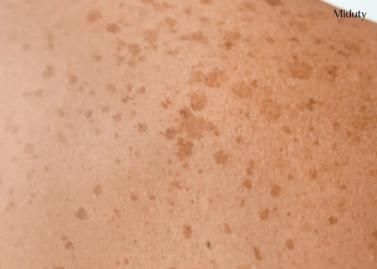 How Aging Affects Skin Pigmentation: Causes, Types, Prevention and Treatment Tips