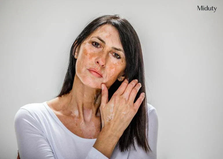 Vitiligo 101: Types, Causes, Symptoms, Diet Tips, and Treatments