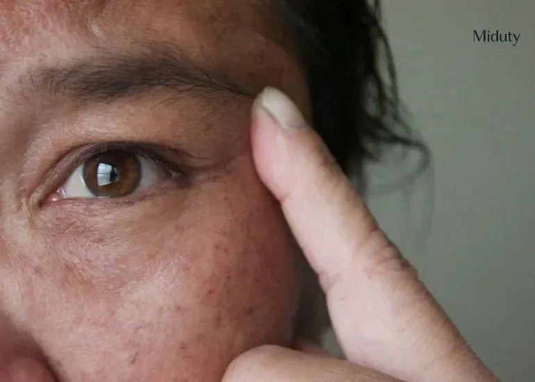 Post-Inflammatory Hyperpigmentation - Causes, Symptoms and Treatments