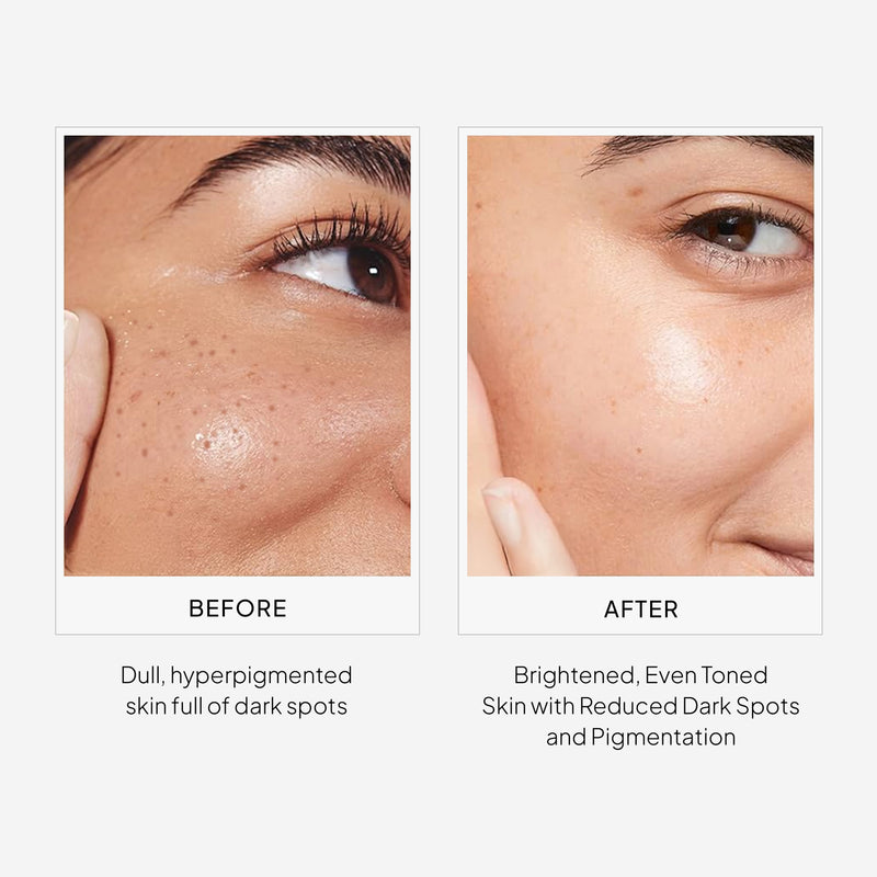 Before and After Results for Miduty Epilight - Best Serum for Pigmentation